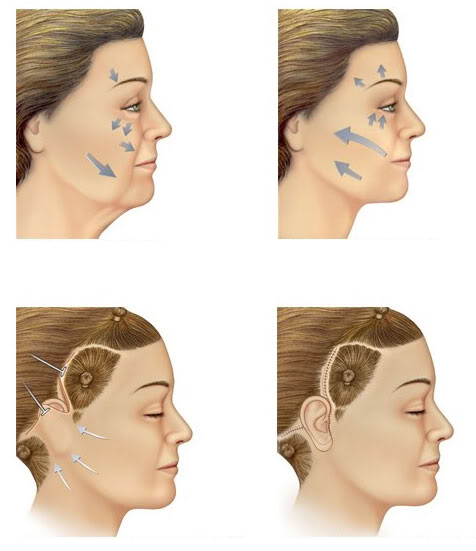 desenho demonstra formas de realizar a cirurgia de lifting facial